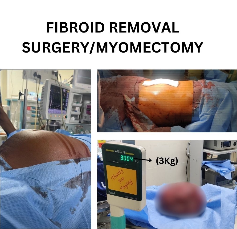 3 Kg Fibroid Successfully Removed