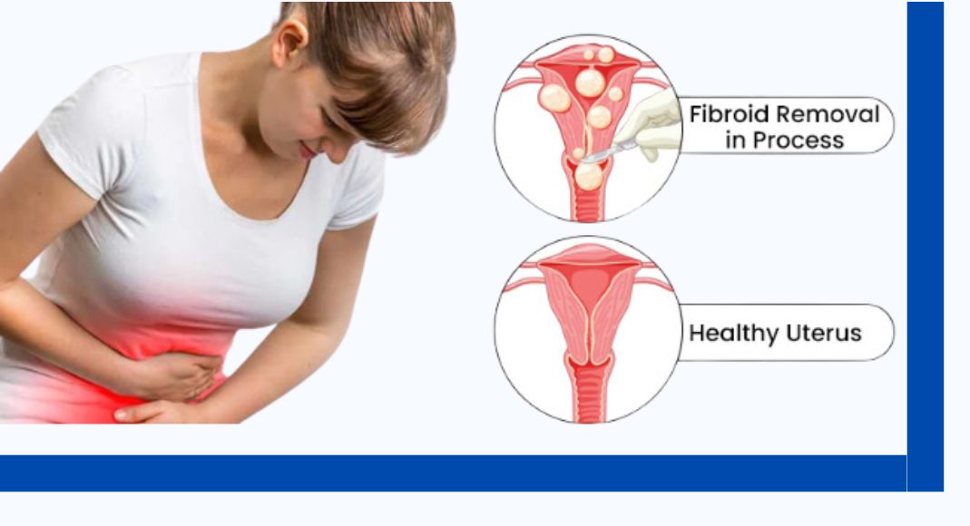 Best Myomectomy Surgery for Uterine Fibroid Relief in Bangalore